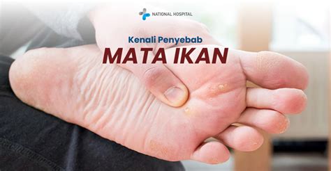 kenali penyebab mata ikan faktor risiko gejala awal  pencegahannya