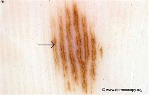 Acral-lentiginous melanoma