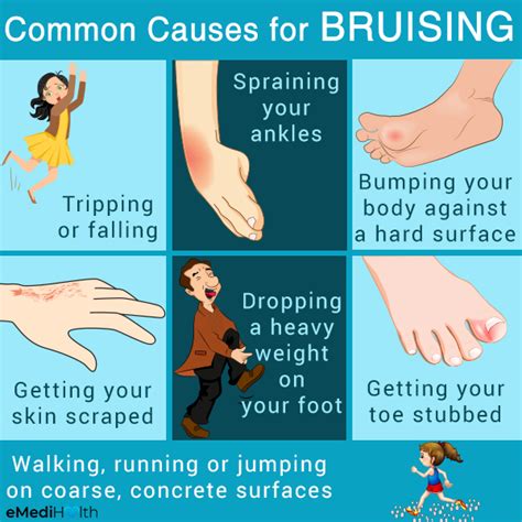 Possible Reasons and Risk Factors for Bruises - eMediHealth