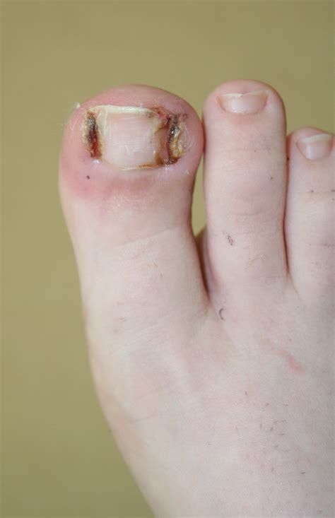 Ingrown Toenail Surgery - Buderim Podiatry | Sunshine Coast podiatrist | foot care | Ainslie Davies