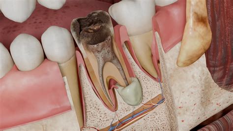 condensing osteitis  symptoms  treatment