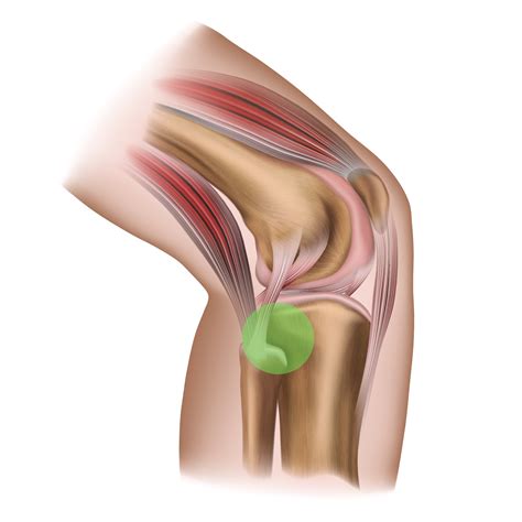 Dealing with Fibular Head Pain: Causes and Solutions - Sport Doctor London