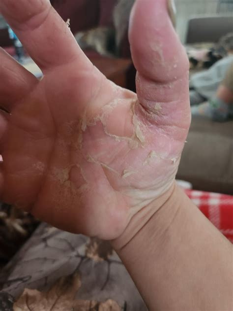started terbinafine : r/NailFungus
