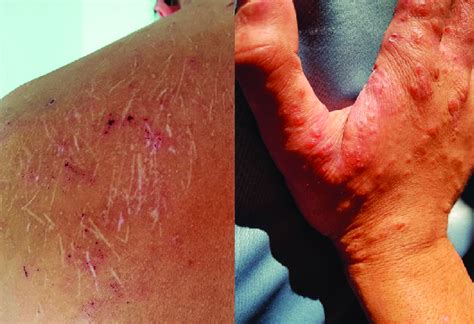 Scabies lesions all over the body in different stages of evolution ...