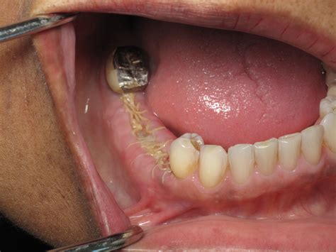 Dental Bone Graft Recovery Pain at Dorla Walker blog