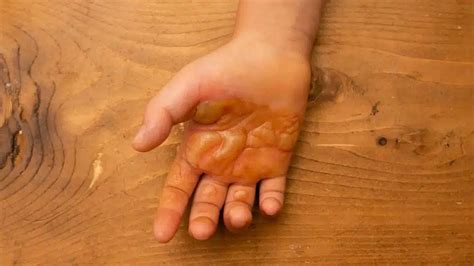 blisters    aid advice  treatment