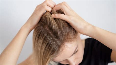 9 Home Remedies For Managing Scalp Psoriasis Effectively | OnlyMyHealth