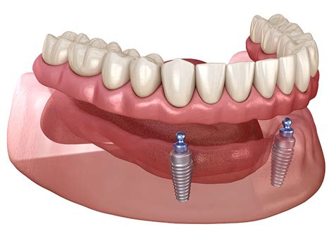 implant supported overdenture woodbridge hill dental practice