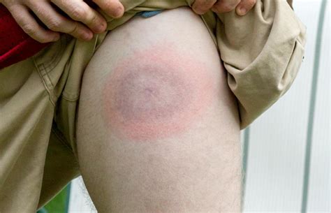 Lyme Disease Rash Name at Valerie Saunders blog