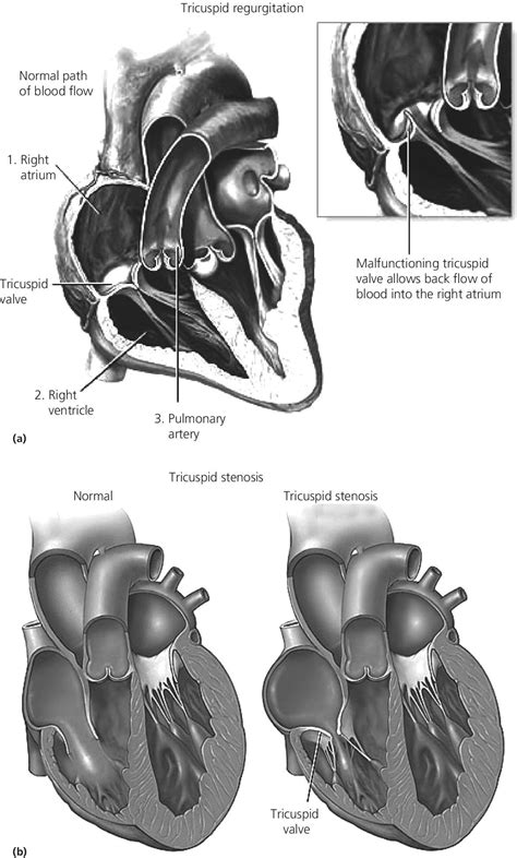 13: The tricuspid valve | Thoracic Key