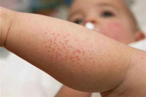 eczema on baby - pictures, photos