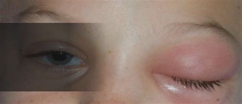 Cavernous Sinus thrombosis causes, symptoms, complications, treatment