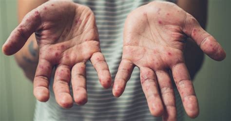 waspada inilah  ciri ciri hiv  kulit    kenali