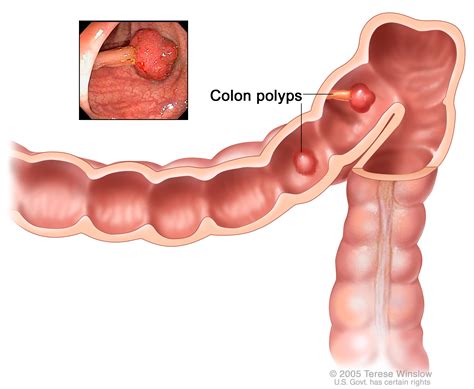 Colon Cancer Diagnosis