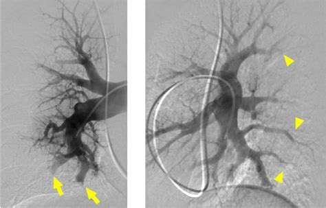 Digital subtraction pulmonary angiography performed in... | Download ...