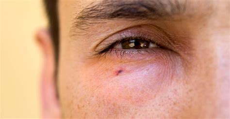 quoi faire piqure  abeille  zane pellot blog