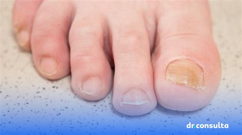 Ponta Das Unhas Amarelas - Estou ficando com as unhas amarelas. O que fazer? | Blog dr.consulta