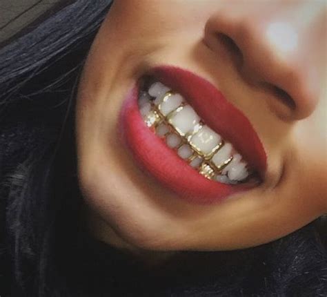 Permanent gold teeth