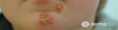 Borkenflechte (Impetigo contagiosa) - Ursachen & Therapie | derma.plus