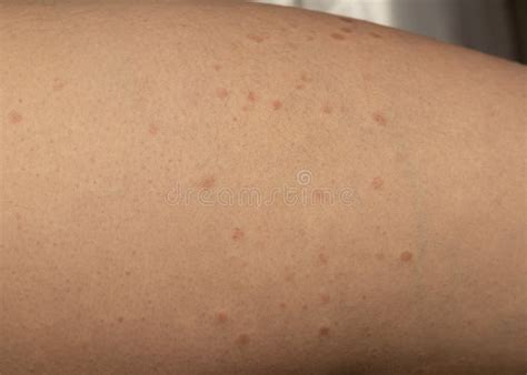 Burn Spots from Laser Skin Treatment for Body Hair Removal. Burns Stock ...