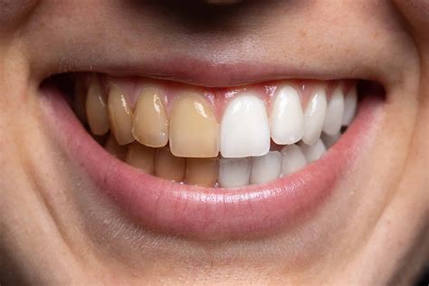 How To Whiten Teeth At Home? - Online Women in Politics