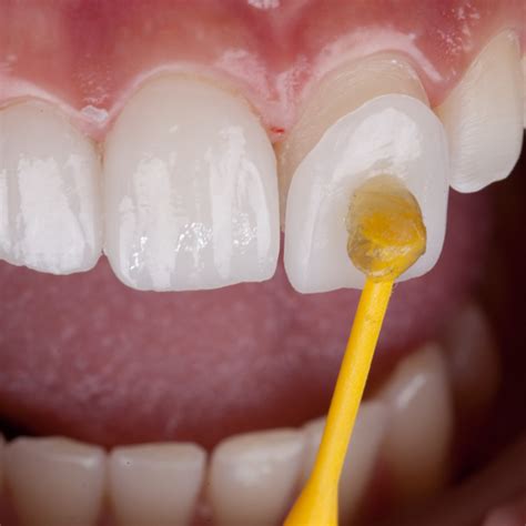 facetas de porcelana odontologia marquini