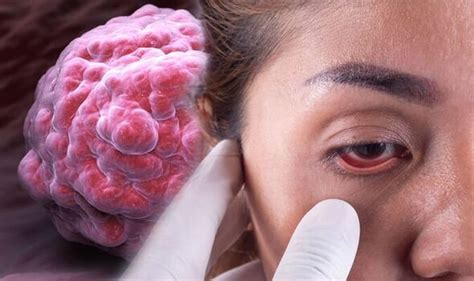 Chlamydia: Symptoms of the STI could include pink-eye | Express.co.uk