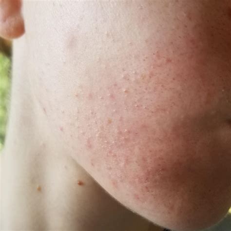 [Routine help] Bumpy skin texture after using CerVa Moisturizing Cream