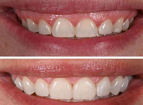 gummy smile treatments london london lip clinic