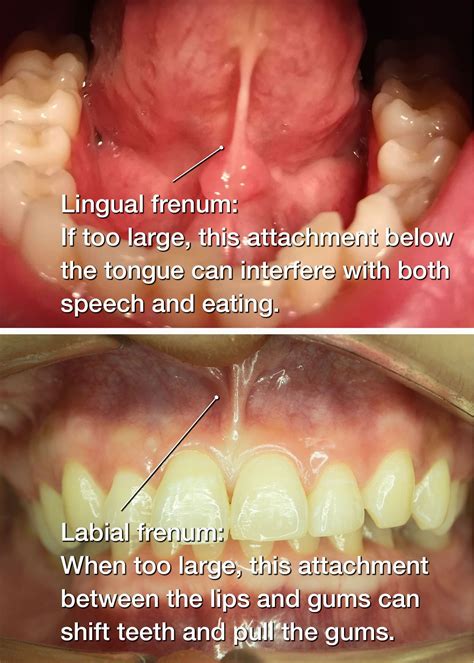 Labial Frenectomy