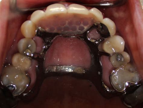 case  metal upper partial denture  mouth