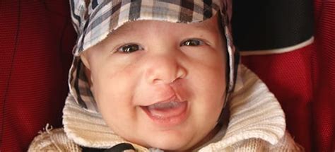 Causes and Treatments for Cleft Lip and Palate | OMSNashville TN