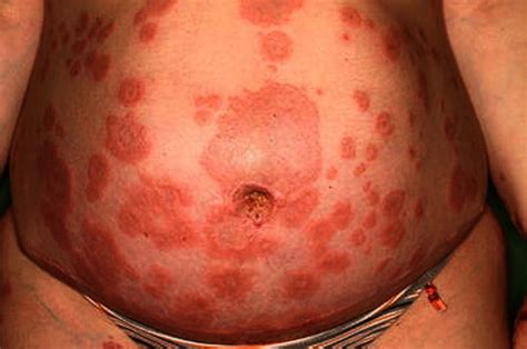 Image:Pemphigoid Gestationis-MSD Manual Consumer Version