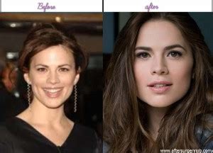 Pics Of Hayley Atwell Right After Ahead Of Surgery | Celeb Surgery Inc