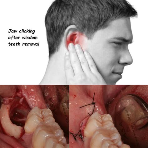 wisdom teeth removal wisdom teeth removal spectrum health