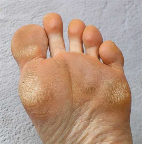 Corns and Calluses Removal and Treatment | Foot And Ankle