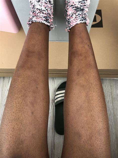 Black people, do you have random bruises on your legs too? : r/Fibromyalgia