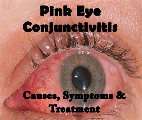 Understanding Pink Eye Conjunctivitis - Causes and Treatment
