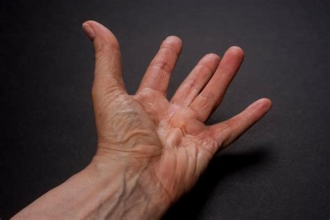 Dupuytren’s Disease - Hand Surgery – Hand Specialist | Montreal & Ottawa | Clinic Specializing ...