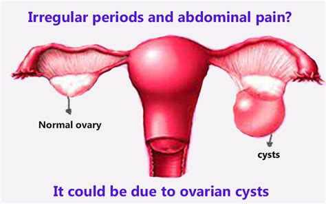 Irregular periods and abdominal pain? It could be due to ovarian cysts