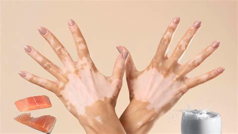 Can Drinking Milk After Eating Fish Cause Skin Diseases? - Boldsky.com