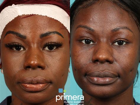 laser facial orlando  michele bodden blog