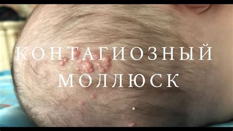 Контагиозный моллюск - YouTube