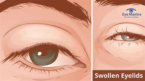 swollen eyelid  makeup treatment makeupviewco
