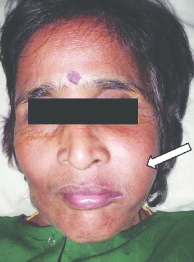 case   year  female   huge swelling   left cheek