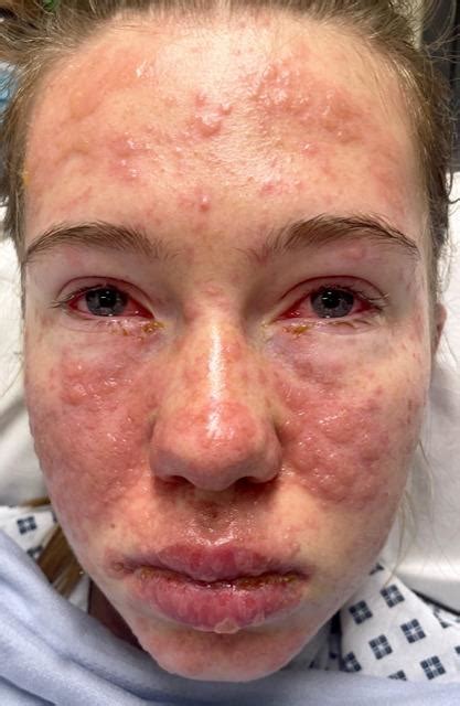 Steven Johnson Syndrome Philadelphia Stevens Johnson Syndrome (SJS)