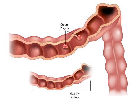 Answering FAQs About Colon Polyps - Atlanta | Piedmont Colorectal