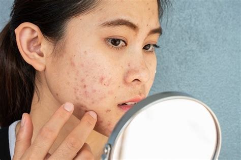 jerawat gejala penyebab  mengobati alodokter