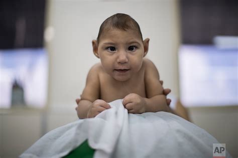 Zika syndrome: Health problems mount as babies turn 1 — AP Photos