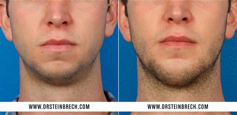 Chin Implant Photos - Dr. Douglas Steinbrech